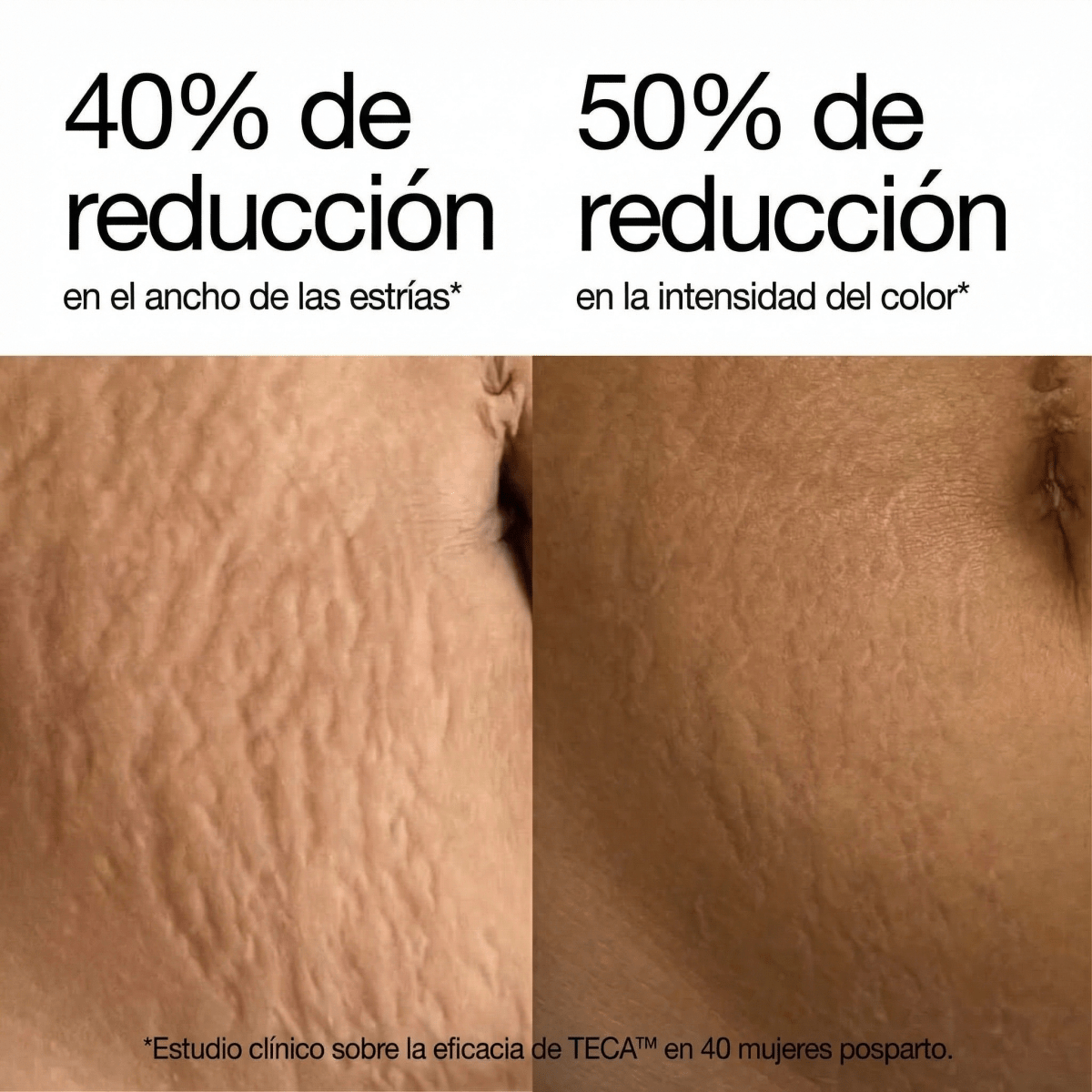 Redefiniendo la crema para estrías - Solvia ES