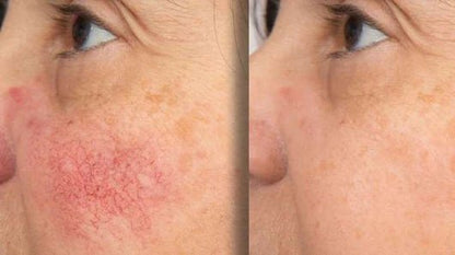 Solvia Sérum Anti - Rojeces - Solvia ES
