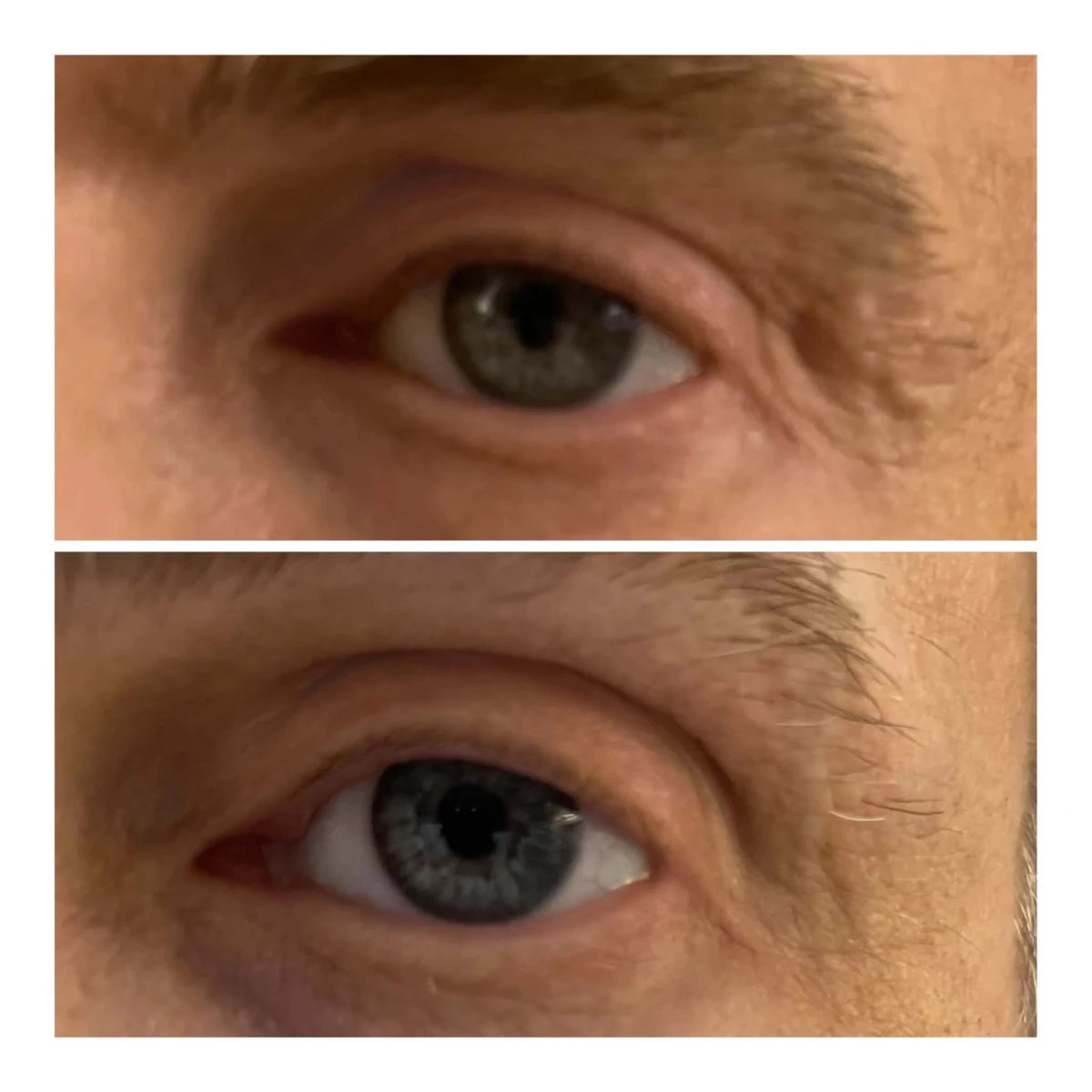 VARITA LIFTING DE OJOS - Solvia ES