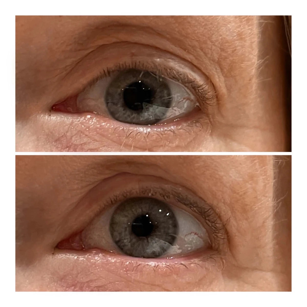 VARITA LIFTING DE OJOS - Solvia ES