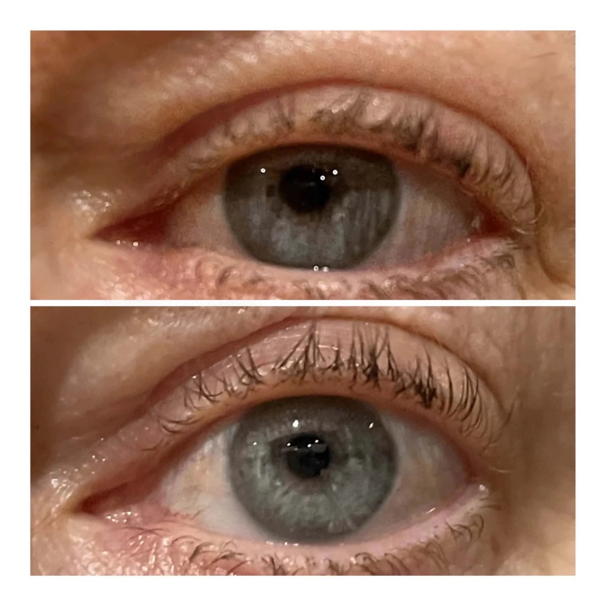 VARITA LIFTING DE OJOS - Solvia ES